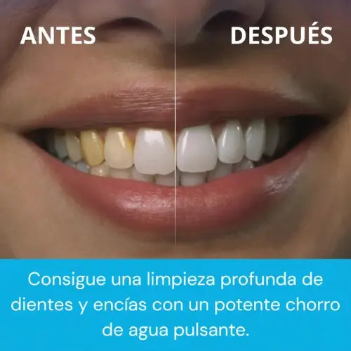 PureSmile Pro - Elimina el sarro en minutos