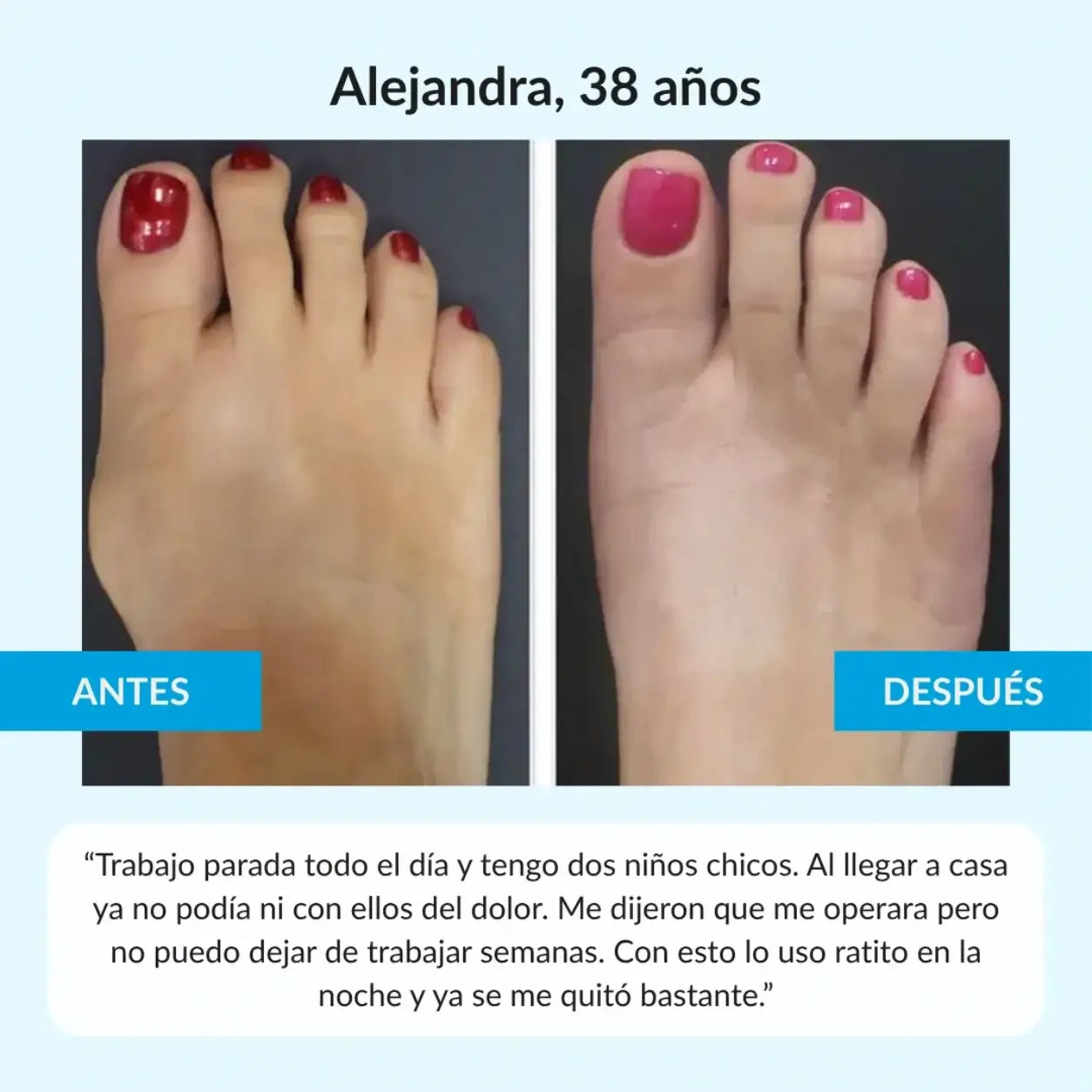 PodoCor - Corrige juanetes mientras haces tu vida normal