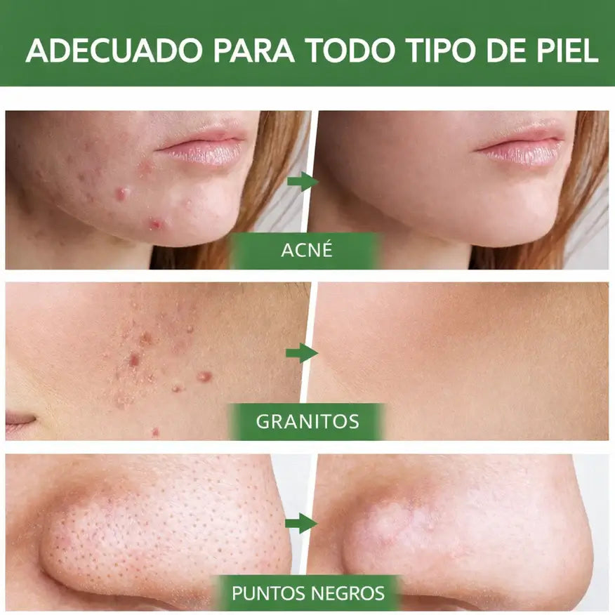 PureBar – Piel limpia y sin puntos negros en minutos